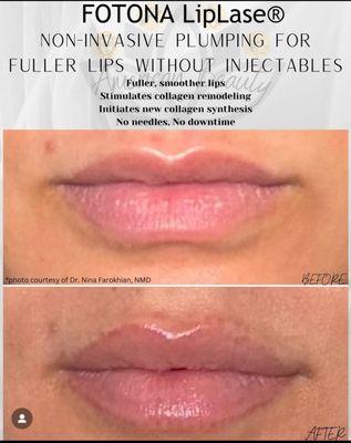 Non-injectable laser treatment for plumper lips with Fotona LipLase