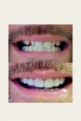 NO shots  veneers.(6)