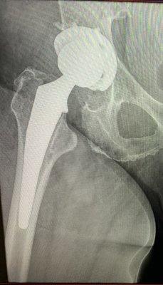 My hip replacement. New hip new ball new socket!