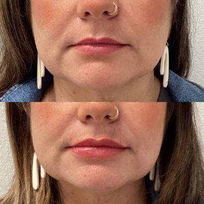 Before and after dermal filler in lips