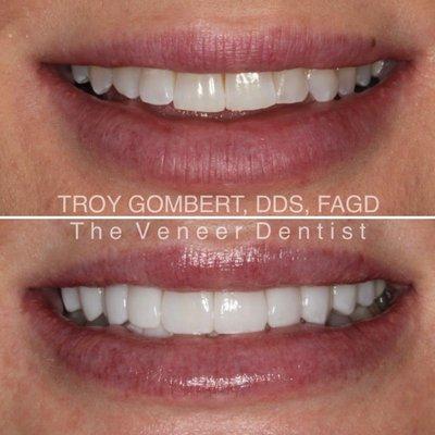 smile makeover with veneers.