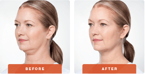 Kybella Before and After