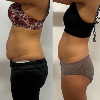 Body Mix Contouring before and after