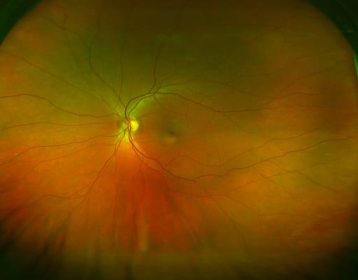 This is the Optomap Retinal Imaging that we offer in place of dilation, call us to ask about it now!