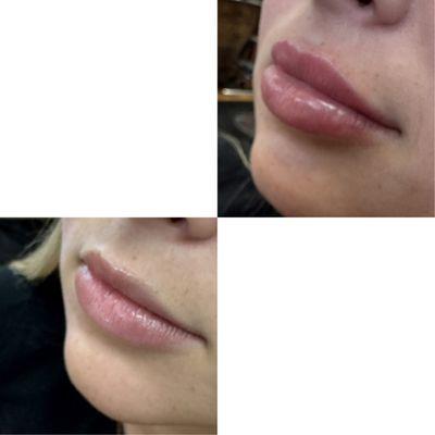 Lip Filler