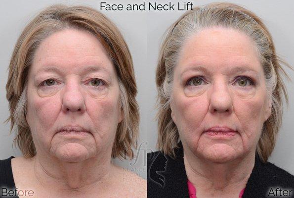 The face and neck lift can provide striking results, contouring the neck line while taking years off of the apparent age of the face.