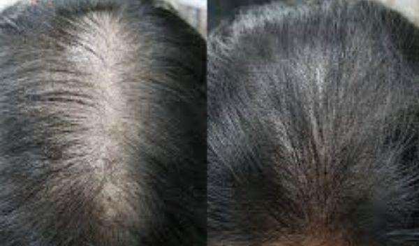 Scalp therapy before and after (multiple treatments)