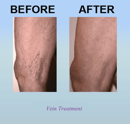 Vein Treatment