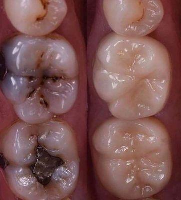 Composite fillings