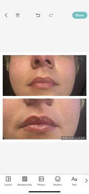 Before after filler