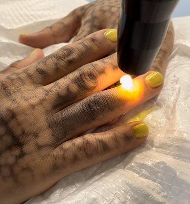 CARBON LASER PEEL FOR HANDS. Brighten and tightens for fresh and younger looking hands. Pain free, quick, and effective.