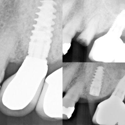 Extraction, graft and immediate implant placement.