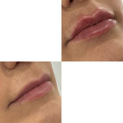 Lip Filler
Half syringe