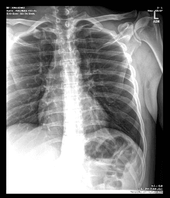 you need to be blind not to seee the fracture left rib 5 and 6