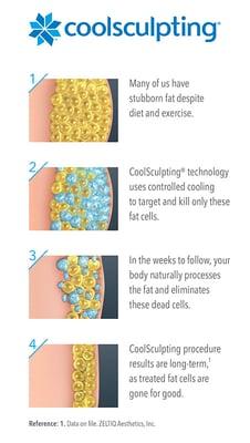 CoolSculpting Process