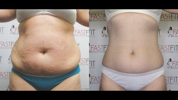 Fast Fit Body Sculpting Fat Weight Loss Review Before and After Skin Tightening