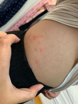 Bed bug bite