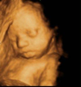 3D Ultrasound Houston tx of baby at 28 weeks pregnant