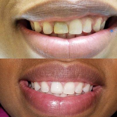 Teeth Whitening, Veneers, Crowns