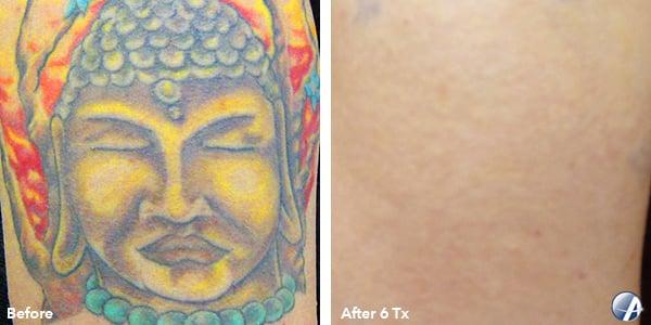 Eastern Idaho Tattoo Removal