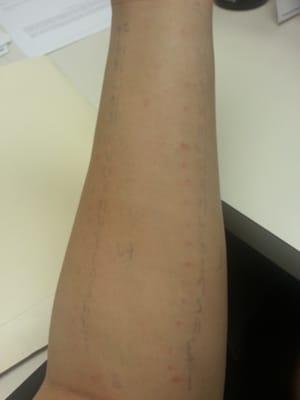 Allergy test! I wanted to scratch so bad, but I couldn't for 20 minutes!