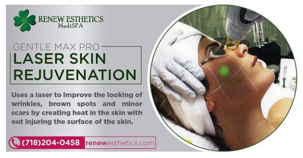 The result of tighter, smoother skin is immediate. In addition to the initial thickening of collagen, heating collagen fibers