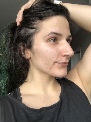 My skin now! May 2019 :) no make up nothing!!!