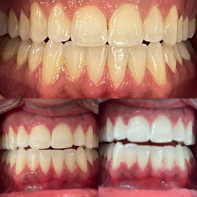 Teeth Whitening