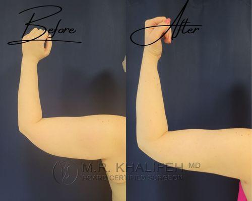 Arm Lipo