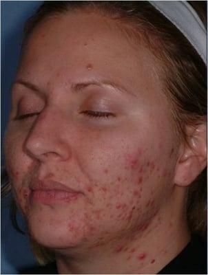 Acne & Scar Reduction Treatment Before