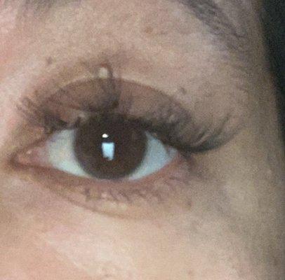 4 days after set right eye