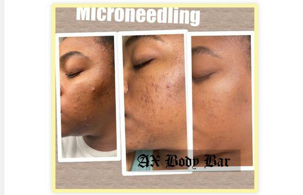 Microneedling