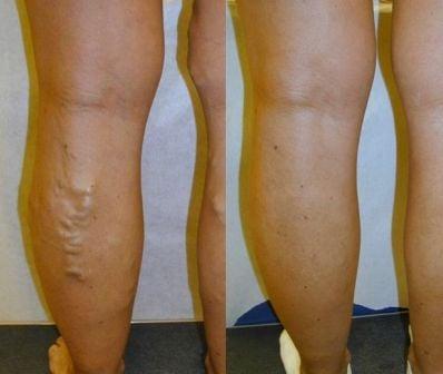 Varicose veins on female calves - Memphis, TN