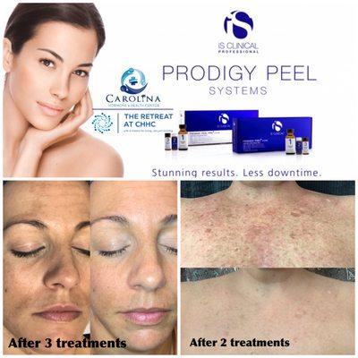 Prodigy Pro Peel