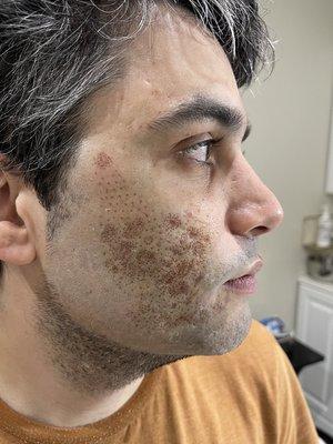 Acne scarring treatment