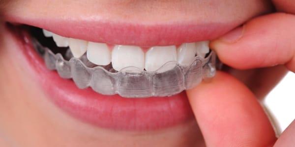 Olmsted Orthodontics offers customized and cosmetic smile options for you with Invisalign and clear or invisible braces.