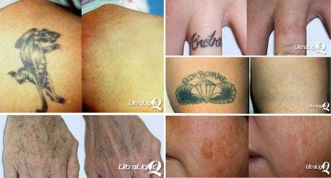 Tattoo removal