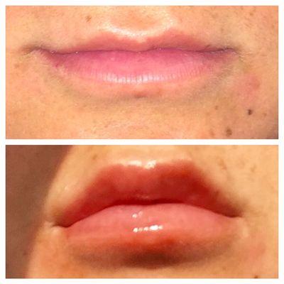 Before and after - beautiful lip augmentation