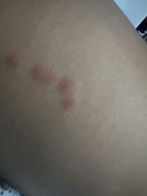 Bed bugs rash