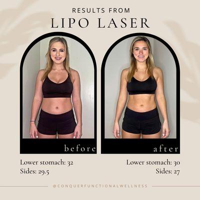 Offering Lipo Laser for non-invasive weight loss