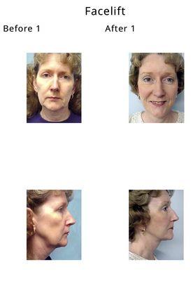 Facelift before and after