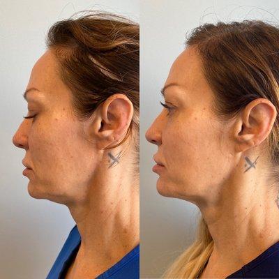 Morpheus 8. Skin Tightening Full Face, Jawline and Neck. Series of 3 needed. Photos after just one treatment.