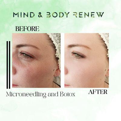 Microneedling and Botox