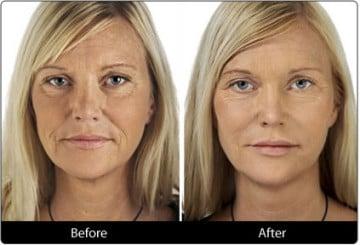 Botox & Dermal Filler