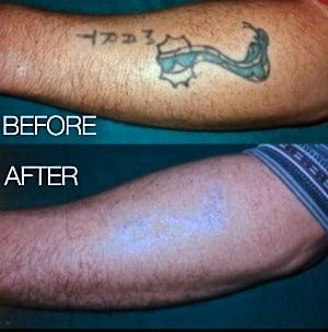 Call Lasercare Tattoo Removal for your free consultation, 907.903.1558.