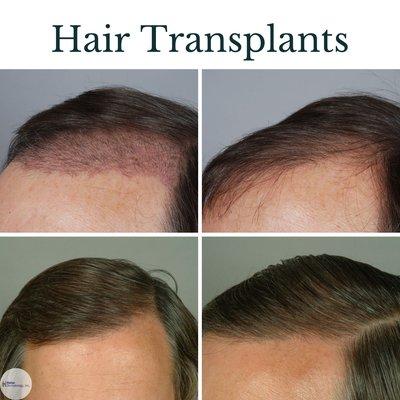 Hair transplant patient