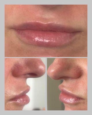 Add subtle volume with lip filler