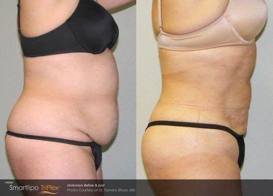 SmartLipo Before and After Photos