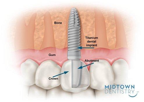 Dental Implants Are The New Standard