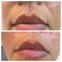 Hyaluronic Needless injections...... AMAZING!